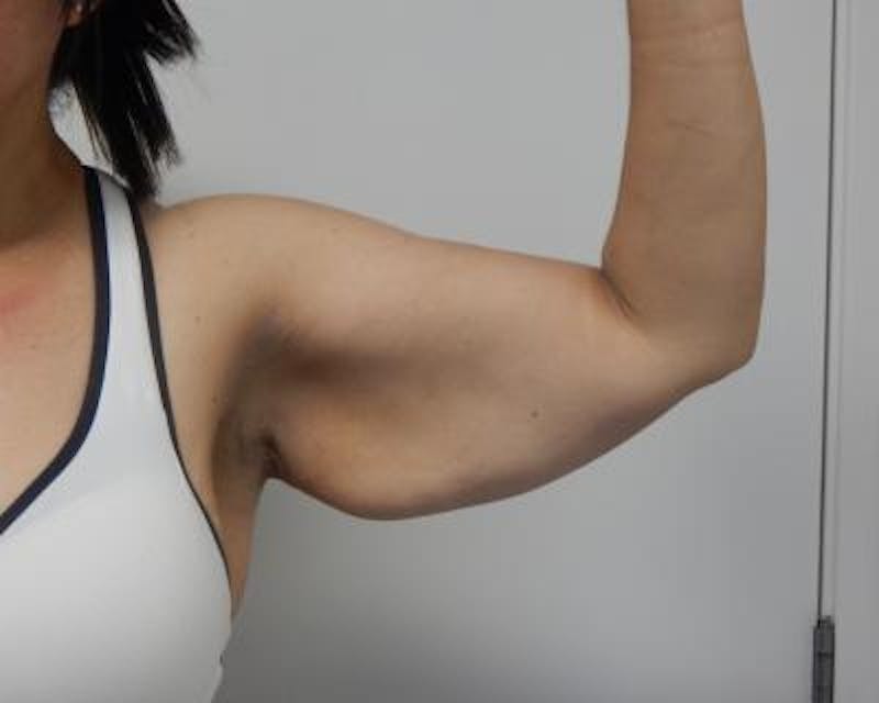 Arm Lift Before & After Gallery - Patient 120351746 - Image 1