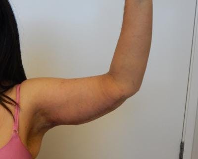 Arm Lift Before & After Gallery - Patient 120351746 - Image 2