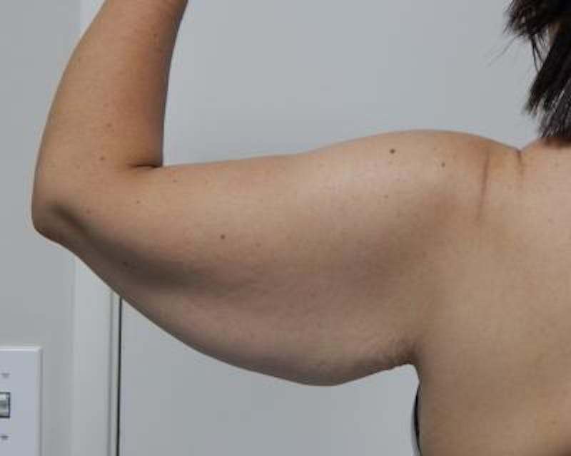 Arm Lift Before & After Gallery - Patient 120351746 - Image 3