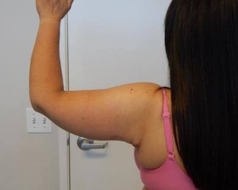 Arm Lift Gallery - Patient 120351746 - Image 4