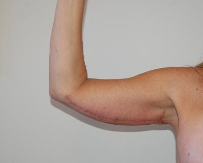 Arm Lift Before & After Gallery - Patient 120351748 - Image 2