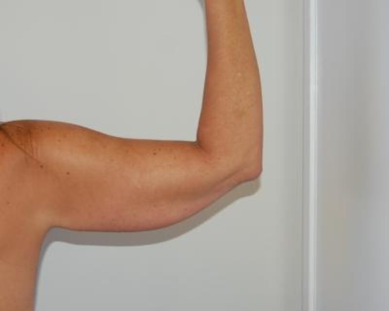 Arm Lift Before & After Gallery - Patient 120351748 - Image 3