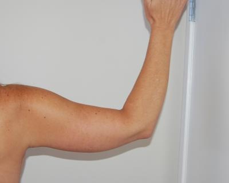 Arm Lift Before & After Gallery - Patient 120351748 - Image 4