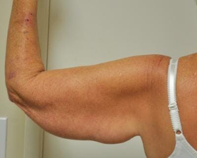 Arm Lift Before & After Gallery - Patient 120351750 - Image 1