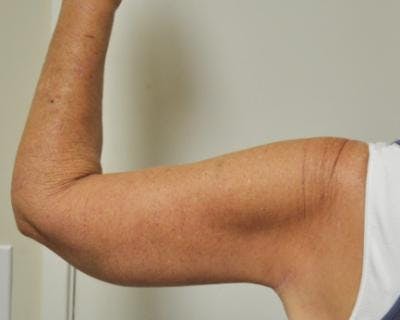 Arm Lift Before & After Gallery - Patient 120351750 - Image 2