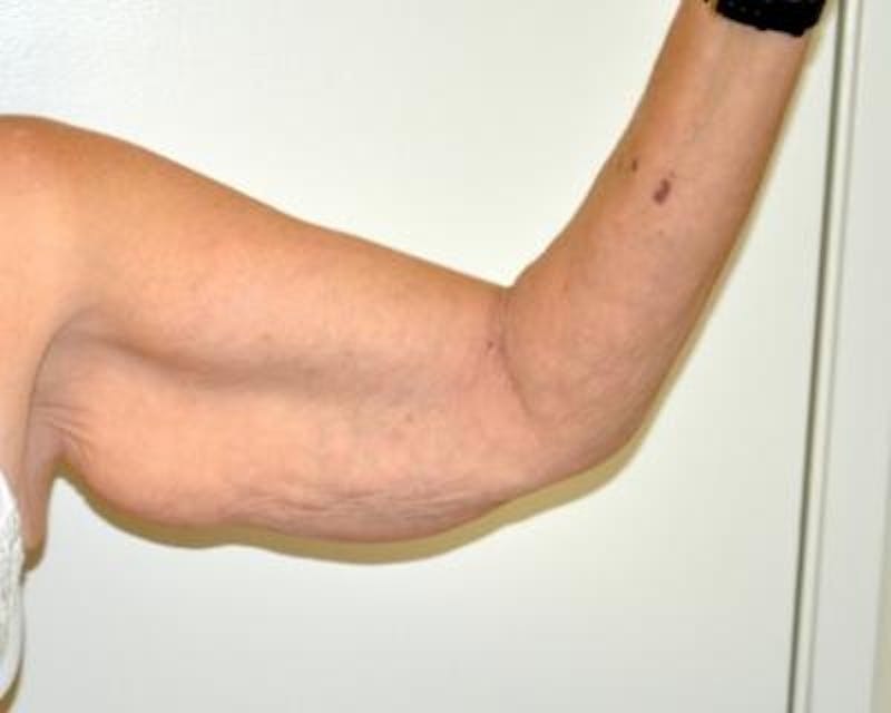 Arm Lift Gallery - Patient 120351750 - Image 3