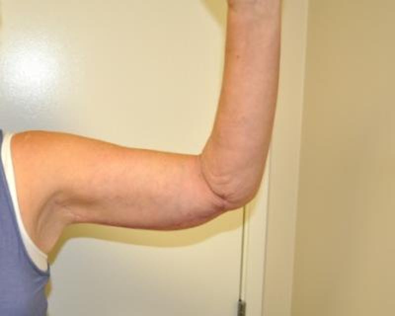 Arm Lift Before & After Gallery - Patient 120351750 - Image 4
