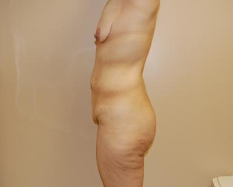 Body Lift Before & After Gallery - Patient 120352949 - Image 3