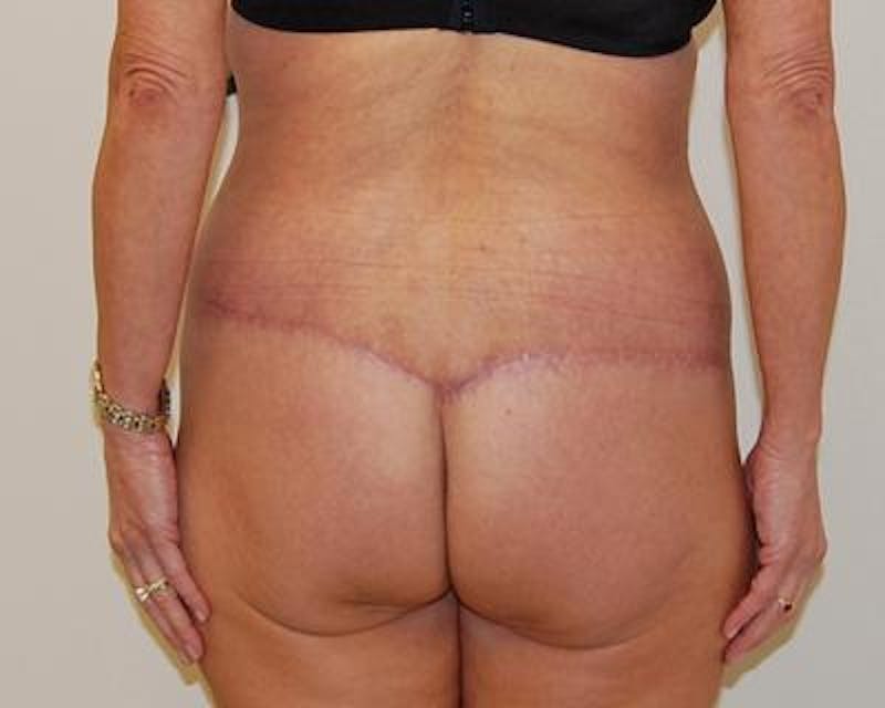 Body Lift Before & After Gallery - Patient 120352950 - Image 4