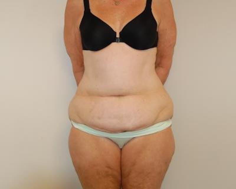 Body Lift Before & After Gallery - Patient 120352980 - Image 1