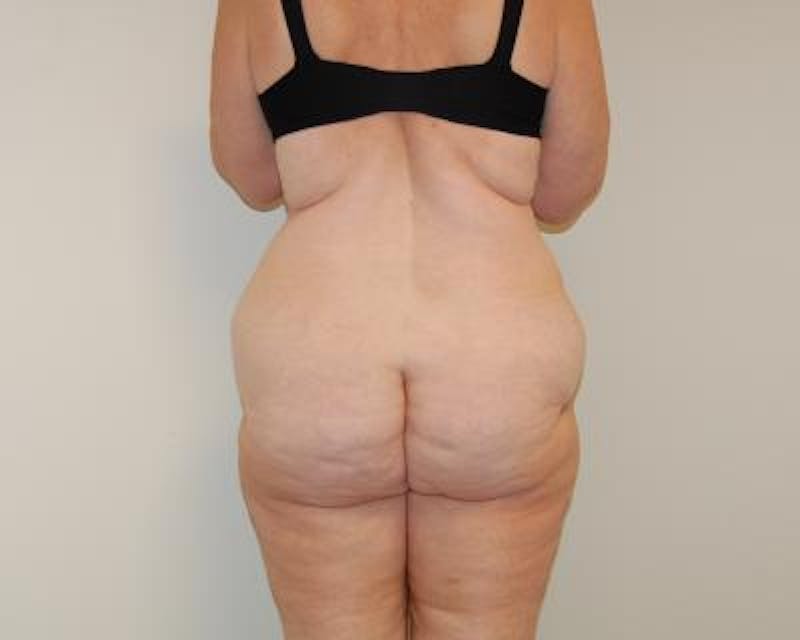 Body Lift Gallery - Patient 120352980 - Image 3