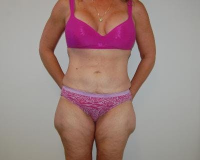 Body Lift Before & After Gallery - Patient 120352981 - Image 1