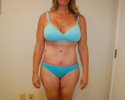 Body Lift Before & After Gallery - Patient 120352981 - Image 2