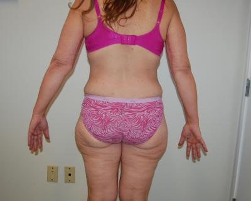 Body Lift Gallery - Patient 120352981 - Image 3