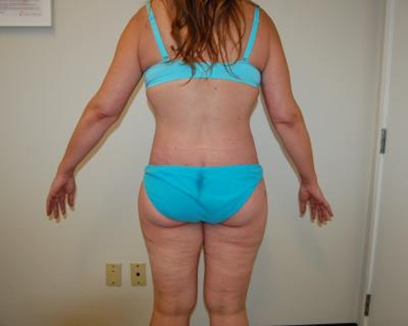 Body Lift Before & After Gallery - Patient 120352981 - Image 4