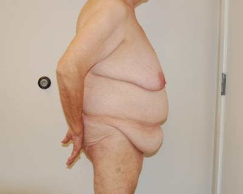 Body Lift Before & After Gallery - Patient 120352983 - Image 3
