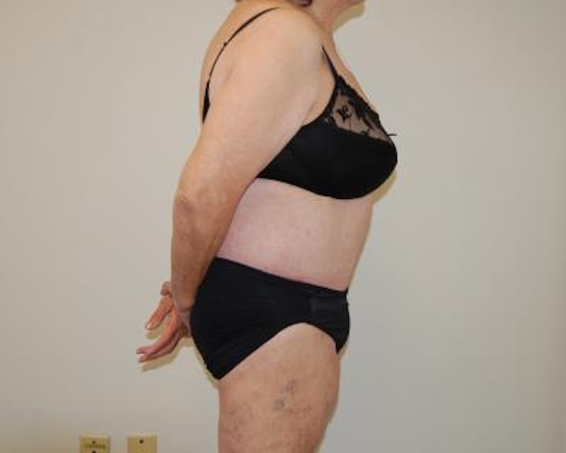 Body Lift Before & After Gallery - Patient 120352983 - Image 4