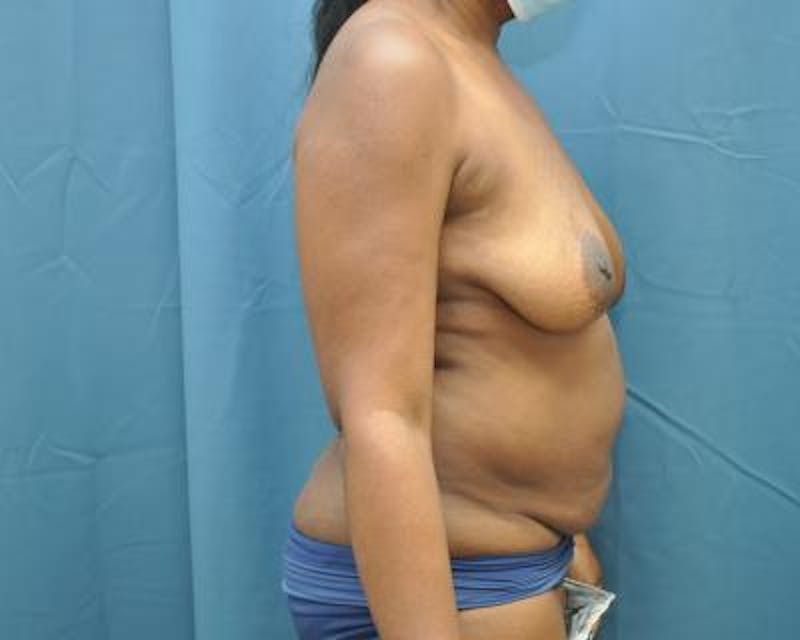 Mommy Makeover Before & After Gallery - Patient 120353595 - Image 5