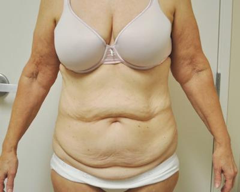 Post-Bariatric Plastic Surgery