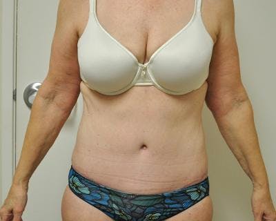Weight Loss Before & After Gallery - Patient 120353654 - Image 2