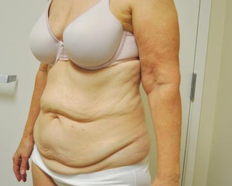 Weight Loss Before & After Gallery - Patient 120353654 - Image 3