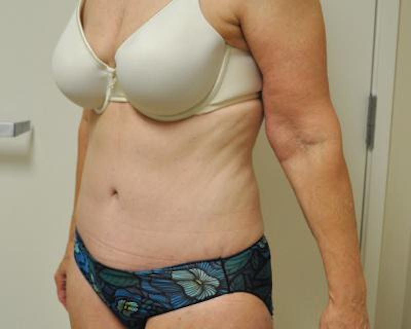 Weight Loss Before & After Gallery - Patient 120353654 - Image 4