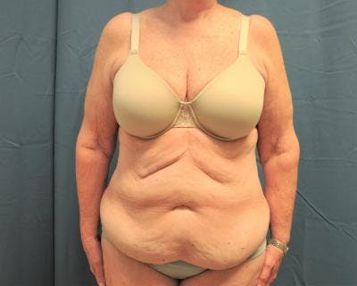 Weight Loss Before & After Gallery - Patient 120353673 - Image 1