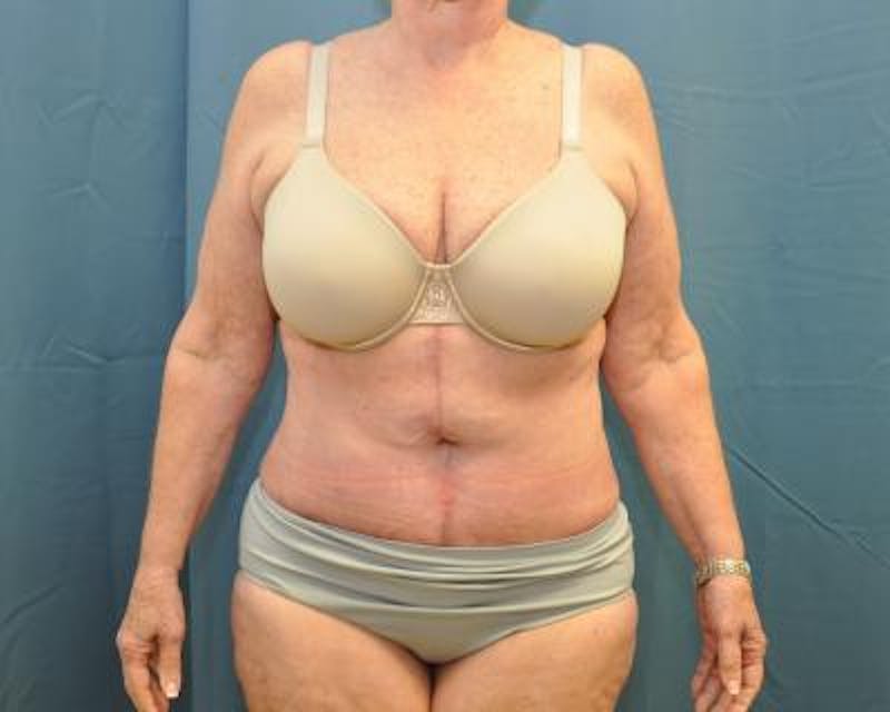 Weight Loss Gallery - Patient 120353673 - Image 2