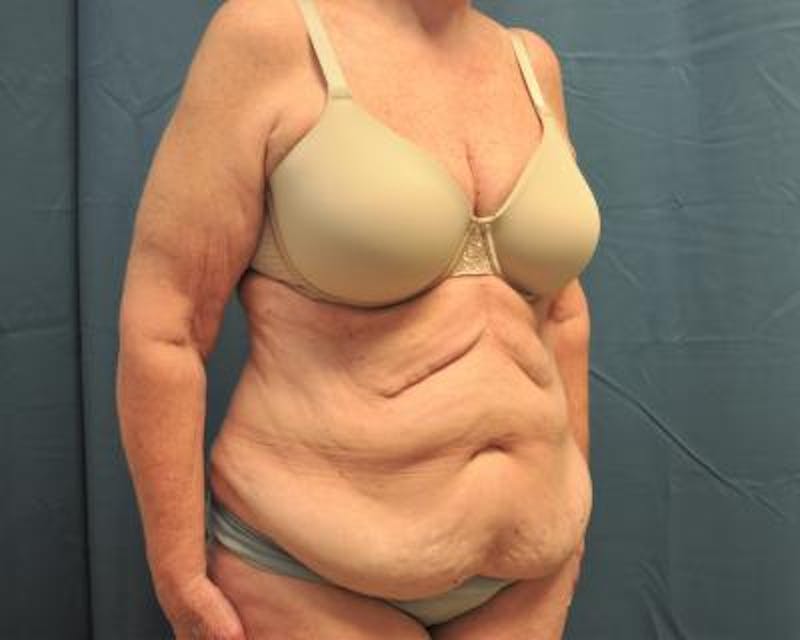 Weight Loss Gallery - Patient 120353673 - Image 3