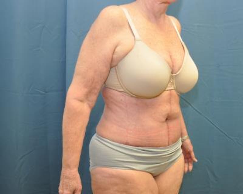 Weight Loss Before & After Gallery - Patient 120353673 - Image 4
