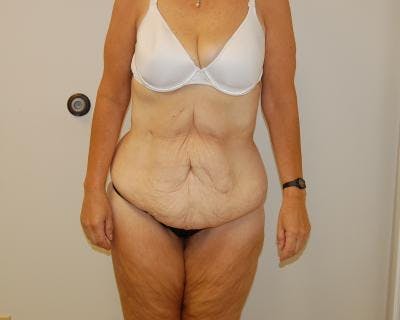 Weight Loss Before & After Gallery - Patient 120353676 - Image 1