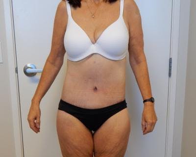 Weight Loss Gallery - Patient 120353676 - Image 2