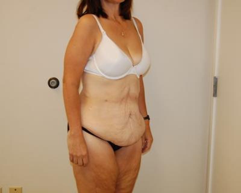 Weight Loss Before & After Gallery - Patient 120353676 - Image 3