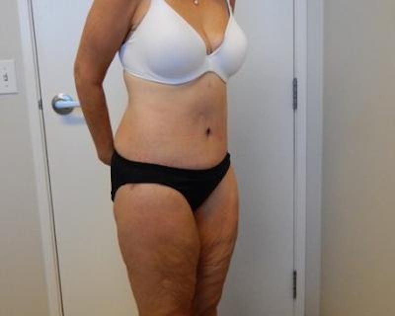 Weight Loss Before & After Gallery - Patient 120353676 - Image 4