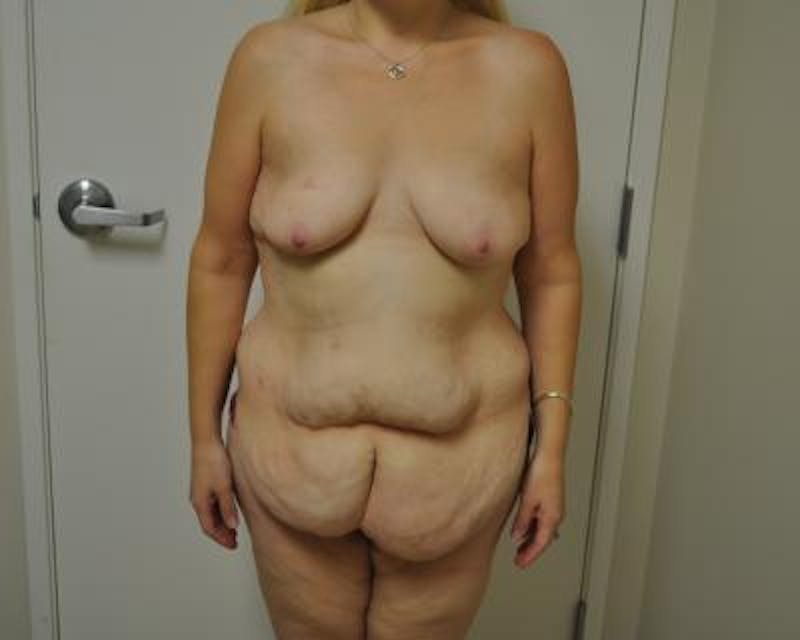Weight Loss Gallery - Patient 120353678 - Image 1