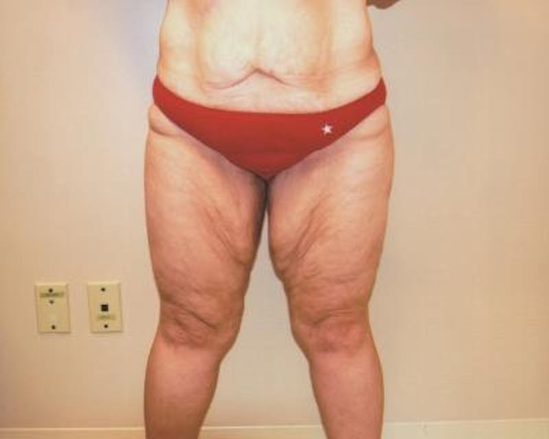 Thigh Lift Before & After Gallery - Patient 120354166 - Image 1