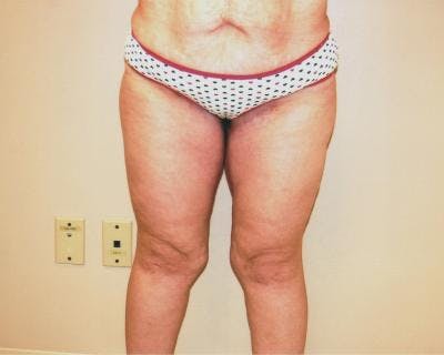 Thigh Lift Before & After Gallery - Patient 120354166 - Image 2