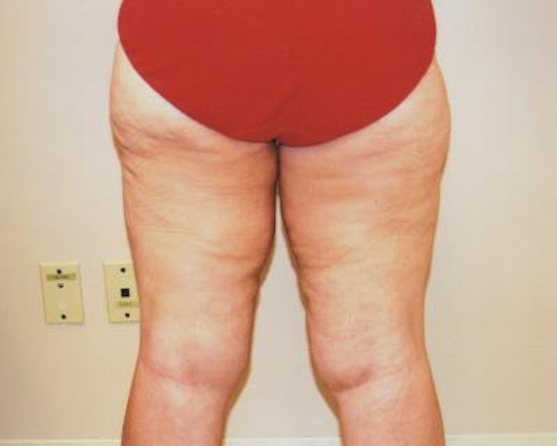 Thigh Lift Gallery - Patient 120354166 - Image 3