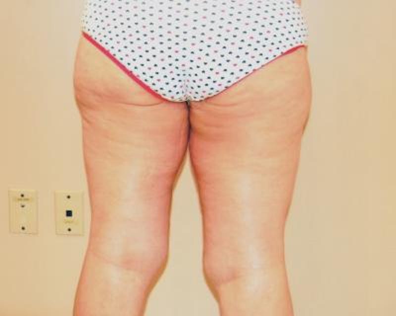 Thigh Lift Gallery - Patient 120354166 - Image 4