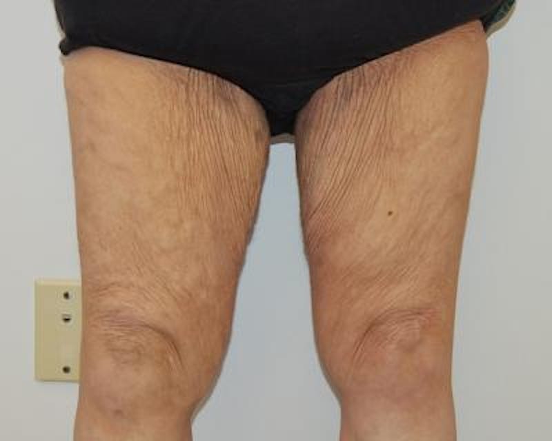 Thigh Lift Before & After Gallery - Patient 120354167 - Image 1