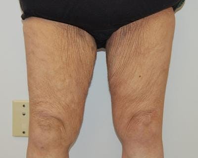 Thigh Lift Before & After Gallery - Patient 120354167 - Image 1