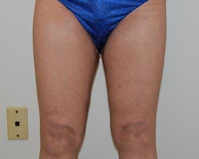 Thigh Lift Before & After Gallery - Patient 120354167 - Image 2