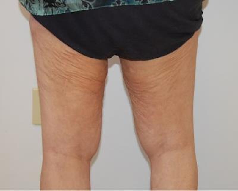 Thigh Lift Gallery - Patient 120354167 - Image 3