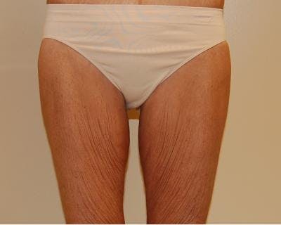 Thigh Lift Before & After Gallery - Patient 120354170 - Image 1