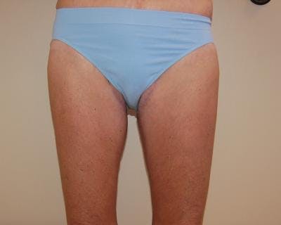 Thigh Lift Gallery - Patient 120354170 - Image 2