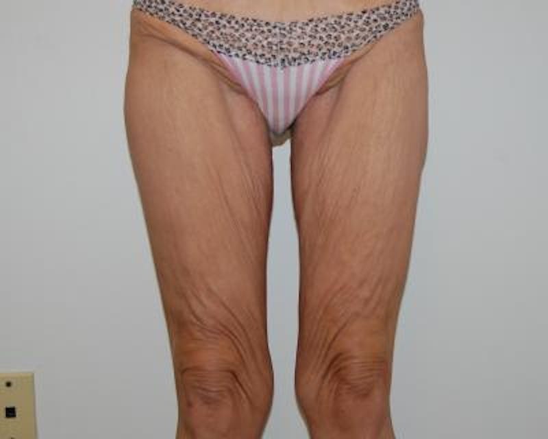 Thigh Lift Before & After Gallery - Patient 120354182 - Image 1