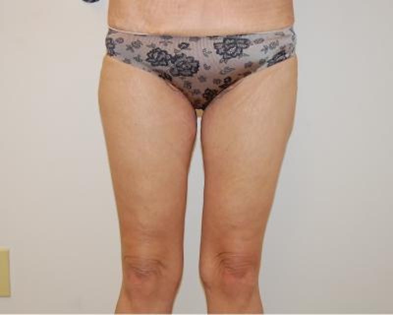 Thigh Lift Gallery - Patient 120354182 - Image 2