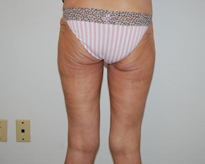 Thigh Lift Before & After Gallery - Patient 120354182 - Image 3