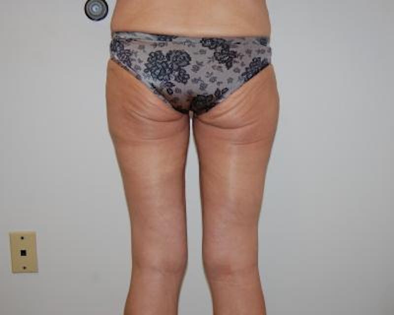 Thigh Lift Before & After Gallery - Patient 120354182 - Image 4