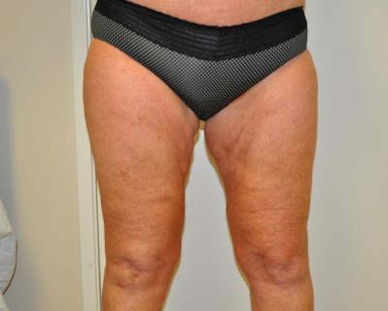 Thigh Lift Gallery - Patient 120354190 - Image 1